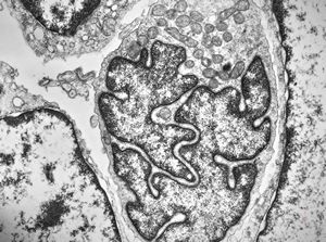 F, 57y. | mycosis fungoides … cerebriform nucleus of Sézary cell